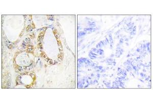 Immunohistochemistry analysis of paraffin-embedded human colon carcinoma tissue using Mucin 13 antibody. (MUC13 Antikörper  (C-Term))