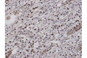 IHC-P Image Immunohistochemical analysis of paraffin-embedded human gastric cancer, using EAR2 , antibody at 1:100 dilution. (NR2F6 Antikörper  (C-Term))