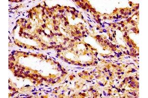IHC image of ABIN7146424 diluted at 1:100 and staining in paraffin-embedded human prostate cancer performed on a Leica BondTM system. (CAMKK2 Antikörper  (AA 5-148))
