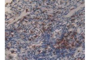 IHC-P analysis of Human Lung Cancer Tissue, with DAB staining. (MMP 9 Antikörper  (AA 213-399))