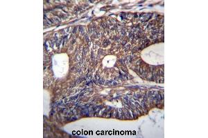 UQCRB Antibody (Center) immunohistochemistry analysis in formalin fixed and paraffin embedded human colon carcinoma followed by peroxidase conjugation of the secondary antibody and DAB staining. (UQCRB Antikörper  (Middle Region))