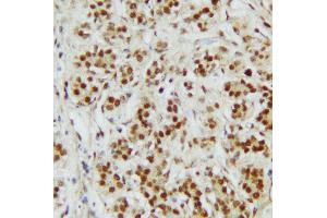 Anti-CTBP2 antibody, IHC(P) IHC(P): Human Mammary Cancer Tissue (CTBP2 Antikörper  (C-Term))