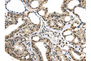The image on the left is immunohistochemistry of paraffin-embedded Human thyroid cancer tissue using ABIN7128063(UCHL3 Antibody) at dilution 1/25, on the right is treated with fusion protein. (UCHL3 Antikörper)
