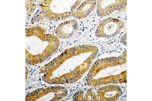 Immunohistochemical analysis of PPOX staining in human colon cancer formalin fixed paraffin embedded tissue section. (PPOX Antikörper)