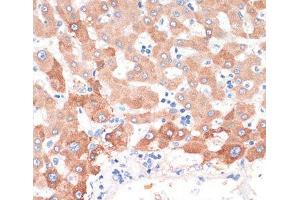 Immunohistochemistry of paraffin-embedded Human liver cancer using CHAT Polyclonal Antibody at dilution of 1:200 (40x lens). (Choline Acetyltransferase Antikörper)