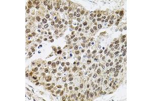 Immunohistochemistry of paraffin-embedded human lung cancer using Smarcd1 antibody (ABIN6132669, ABIN6137420, ABIN6137421 and ABIN6225284) (40x lens).