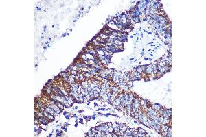 Immunohistochemistry of paraffin-embedded Human colon carcinoma using DOK4 Rabbit pAb (ABIN3020721, ABIN3020722, ABIN3020723 and ABIN6213691) at dilution of 1:100 (40x lens). (DOK4 Antikörper  (AA 240-326))