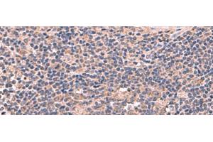 Immunohistochemistry of paraffin-embedded Human cervical cancer tissue using MAGEC2 Polyclonal Antibody at dilution of 1:60(x200) (MAGEC2 Antikörper)