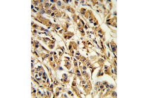Formalin-fixed and paraffin-embedded human breast carcinoma reacted with SREBF1 Antibody (Center), which was peroxidase-conjugated to the secondary antibody, followed by DAB staining. (SREBF1 Antikörper  (AA 349-378))