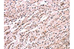 The image on the left is immunohistochemistry of paraffin-embedded Human prostate cancer tissue using ABIN7190608(EXTL1 Antibody) at dilution 1/20, on the right is treated with synthetic peptide. (EXTL1 Antikörper)