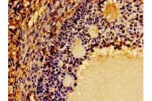 Immunohistochemistry of paraffin-embedded human ovarian cancer using ABIN7149290 at dilution of 1:100 (CD131 Antikörper  (AA 492-710))