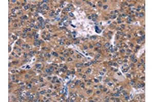 The image on the left is immunohistochemistry of paraffin-embedded Human liver cancer tissue using ABIN7192381(SKI Antibody) at dilution 1/40, on the right is treated with synthetic peptide. (SKI Antikörper)