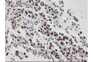 Immunohistochemical staining of paraffin-embedded Carcinoma of Human lung tissue using anti-GTF2F1 mouse monoclonal antibody. (GTF2F1 Antikörper)