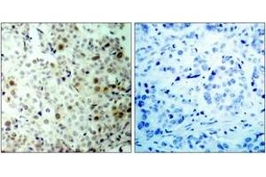 Immunohistochemistry analysis of paraffin-embedded human breast carcinoma, using CDC2 (Phospho-Thr161) Antibody. (CDK1 Antikörper  (pThr161))