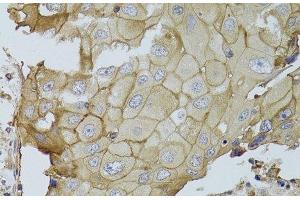 Immunohistochemistry of paraffin-embedded Human breast cancer using GGT1 Polyclonal Antibody at dilution of 1:100 (40x lens). (GGT1 Antikörper)