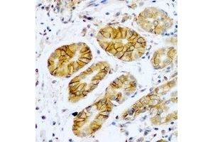 Immunohistochemical analysis of TMPRSS2 staining in human stomach cancer formalin fixed paraffin embedded tissue section. (TMPRSS2 Antikörper)
