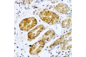 Immunohistochemical analysis of TMPRSS2 staining in human stomach cancer formalin fixed paraffin embedded tissue section.