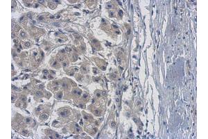 IHC-P Image Immunohistochemical analysis of paraffin-embedded human hepatoma, using PME-1, antibody at 1:500 dilution. (PPME1 Antikörper)