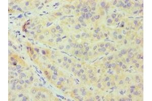 Immunohistochemistry of paraffin-embedded human liver cancer using ABIN7148700 at dilution of 1:100 (CRY1 Antikörper  (AA 507-586))