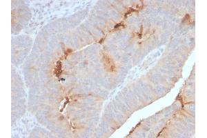 Formalin-fixed, paraffin-embedded human Colon Carcinoma stained with Serum Amyloid A Recombinant Rabbit Monoclonal Antibody (SAA/2868R). (Rekombinanter SAA Antikörper)