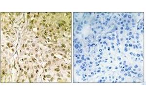 Immunohistochemistry analysis of paraffin-embedded human breast carcinoma, using DNA Polymerase thet Antibody.