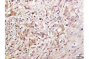 Formalin-fixed and paraffin embedded human gastric carcinoma tissue labeled with Anti-CD34 Polyclonal Antibody, Unconjugated (ABIN676898) at 1:200 followed by conjugation to the secondary antibody and DAB staining