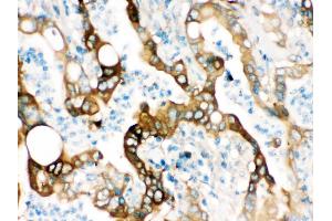 FASN was detected in paraffin-embedded sections of human intestinal cancer tissues using rabbit anti- FASN Antigen Affinity purified polyclonal antibody at 1 μg/mL.