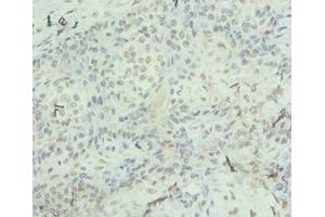 Immunohistochemistry of paraffin-embedded human breast cancer using ABIN7156933 at dilution of 1:100