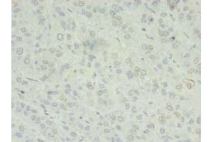 Immunohistochemistry of paraffin-embedded human liver cancer using ABIN7176040 at dilution of 1:100