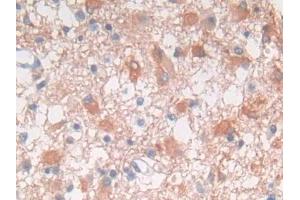 DAB staining on IHC-P; Samples: Human Glioma Tissue (FRK Antikörper  (AA 234-491))