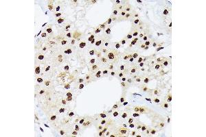 Immunohistochemistry of paraffin-embedded human liver cancer using hnRNP Q/SYNCRIP /SYNCRIP Rabbit mAb (ABIN7270673) at dilution of 1:100 (40x lens). (SYNCRIP Antikörper)