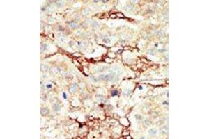 Formalin-fixed and paraffin-embedded human cancer tissue reacted with the primary antibody, which was peroxidase-conjugated to the secondary antibody, followed by DAB staining. (FGFR3 Antikörper  (C-Term))
