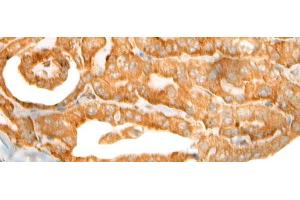 Immunohistochemistry of paraffin-embedded Human thyroid cancer tissue using CEP72 Polyclonal Antibody at dilution of 1:40(x200) (CEP72 Antikörper)