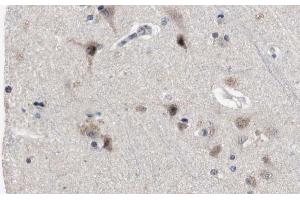 ABIN6272383 at 1/100 staining Human brain cancer tissue by IHC-P.