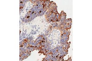 Immunohistochemical analysis of paraffin-embedded Human colon carcinoma tissue using (ABIN391544 and ABIN2841493) performed on the Leica® BOND RXm. (CEACAM5 Antikörper  (N-Term))
