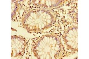Immunohistochemistry of paraffin-embedded human colon cancer using ABIN7150132 at dilution of 1:100