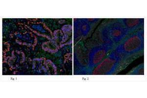 Immunofluorescent analysis of human colon adenocarcinomat tissue (Fig. (PCNA Antikörper)
