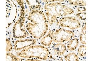 ABIN6260268 and ABIN6276437 at 1/100 staining Human kidney cancer and adjacent normal tissues by IHC-P. (BIRC2 Antikörper  (C-Term))