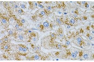 Immunohistochemistry of paraffin-embedded Human liver damage using NPC2 Polyclonal Antibody at dilution of 1:100 (40x lens). (NPC2 Antikörper)