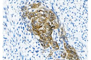 ABIN7093765 and ABIN7097799 at 1/200 staining human liver cancer tissue sections by IHC-P. (Claudin 6 Antikörper)