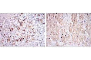 Immunohistochemical analysis of paraffin-embedded breast cancer tissues (left) and cardiac muscle tissues (right) using HSP27 mouse mAb with DAB staining. (HSP27 Antikörper)