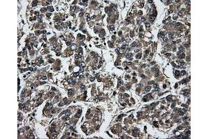 Immunohistochemical staining of paraffin-embedded Carcinoma of liver tissue using anti-GBE1mouse monoclonal antibody. (GBE1 Antikörper)