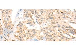 Immunohistochemistry of paraffin-embedded Human esophagus cancer tissue using CCT8L2 Polyclonal Antibody at dilution of 1:45(x200) (CCT8L2 Antikörper)
