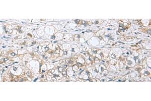 Immunohistochemistry of paraffin-embedded Human liver cancer tissue using PHPT1 Polyclonal Antibody at dilution of 1:210(x200) (PHPT1 Antikörper)