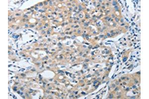 The image on the left is immunohistochemistry of paraffin-embedded Human lung cancer tissue using ABIN7128398(ANAPC13 Antibody) at dilution 1/25, on the right is treated with fusion protein. (ANAPC13 Antikörper)