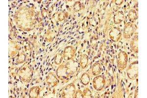 Immunohistochemistry of paraffin-embedded human gastric cancer using ABIN7151097 at dilution of 1:100 (PDZRN3 Antikörper  (AA 133-404))