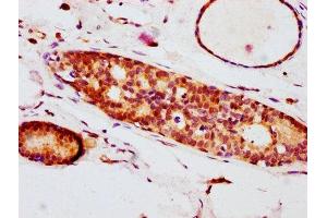 IHC image of ABIN7127691 diluted at 1:100 and staining in paraffin-embedded human breast cancer performed on a Leica BondTM system. (Rekombinanter EIF4E Antikörper  (pSer209))