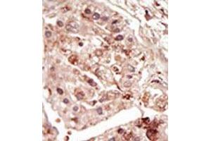 Formalin-fixed and paraffin-embedded human cancer tissue (hepatocarcinoma) reacted with the primary antibody, which was peroxidase-conjugated to the secondary antibody, followed by DAB staining. (STK31 Antikörper  (C-Term))