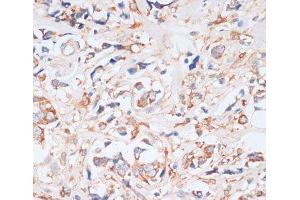 Immunohistochemistry of paraffin-embedded Human breast cancer using EIF4EBP1 Polyclonal Antibody at dilution of 1:100 (40x lens). (eIF4EBP1 Antikörper)