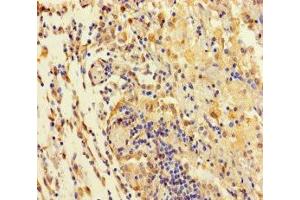 Immunohistochemistry of paraffin-embedded human lung cancer using ABIN7171552 at dilution of 1:100 (TAS2R42 Antikörper  (AA 149-187))